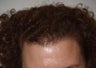 Hair Transplant