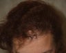 Hair Transplant