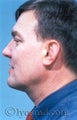 Facial Liposuction