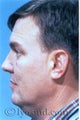 Facial Liposuction