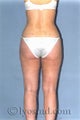 Liposuction
