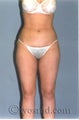 Liposuction