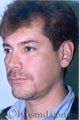 Rhinoplasty, Face and Neck Liposuction, Chin Correction