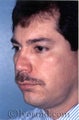 Rhinoplasty, Face and Neck Liposuction, Chin Correction