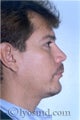 Rhinoplasty, Face and Neck Liposuction, Chin Correction