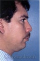 Rhinoplasty, Face and Neck Liposuction, Chin Correction