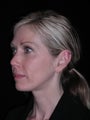 Filler injection perioral area