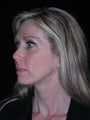 Filler injection perioral area
