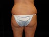 Brazilian Butt Lift