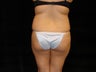 Brazilian Butt Lift