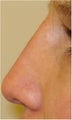 Nonsurgical nose filler with Radiesse