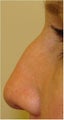 Nonsurgical nose filler with Radiesse