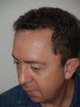 Hair Transplant / 2200 grafts