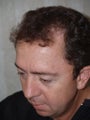 Hair Transplant / 2200 grafts