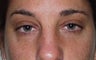 Blepharoplasty