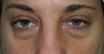 Blepharoplasty