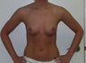 Breast Augmentation