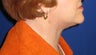 Neck lift