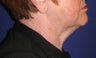 Neck lift