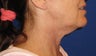 Neck lift