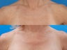 Intense Pulsed Light Laser