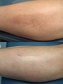 Intense Pulsed Light Laser