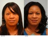 Lip Reduction