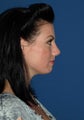 Rhinoplasty