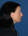 Rhinoplasty