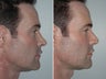 Revision Rhinoplasty