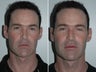 Revision Rhinoplasty