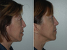 Revision Rhinoplasty
