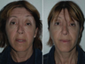 Revision Rhinoplasty