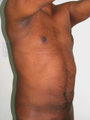 Tummy Liposuction