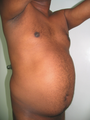 Tummy Liposuction
