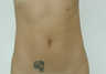 Vaser Liposuction