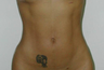 Vaser Liposuction