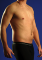 Tummy Liposuction