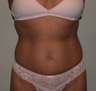 Tummy Liposuction