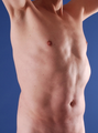 Tummy Liposuction