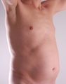 Tummy Liposuction