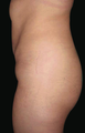 Tummy Liposuction