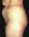 Tummy Liposuction
