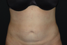 Tummy Liposuction