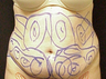 Tummy Liposuction