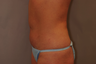 Tummy Liposuction