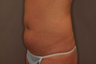 Tummy Liposuction