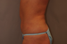 Tummy Liposuction