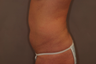 Tummy Liposuction
