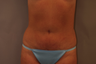 Tummy Liposuction